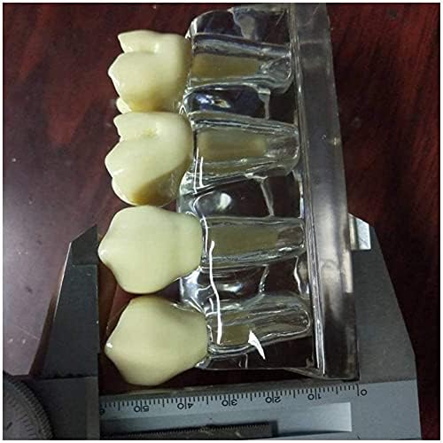 מודל הוראה של PSVOD, מודל שיני שיניים באנטומיה - מודל סגירת סולקוס שיניים - שיניים נגד תולעת מונעת עששת לימוד