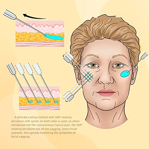 חוטי בורג, בורג דו כיווני 360 ר', מרימים ביעילות את העור ויוצרים אפקט חזותי של פנים וי, בוטה מסוג