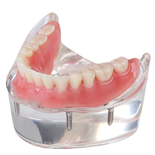 מודל שיקום שיניים של Soarday עם 4 שתלים יתר על המידה מודל לימוד נחות מודל שיניים