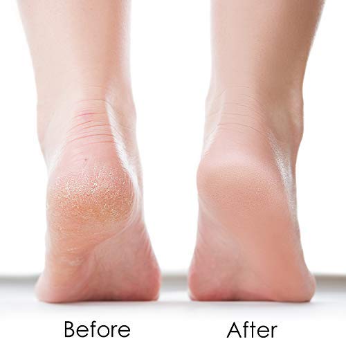 מסכת מסיר יבלת כף הרגל לעור מת, יבש ומתקלף, רגלי עקבים מחוספסות פילינג פילינג פילינג גורם לעור רך, משיי